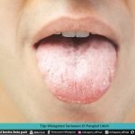 TIPS MENGATASI SARIAWAN DI PANGKAL LIDAH
