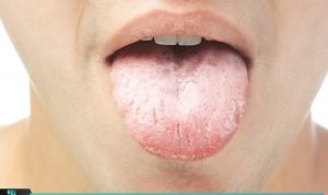 TIPS MENGATASI SARIAWAN DI PANGKAL LIDAH