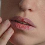 Bibir Kering dan Pecah-pecah, Ini Solusinya